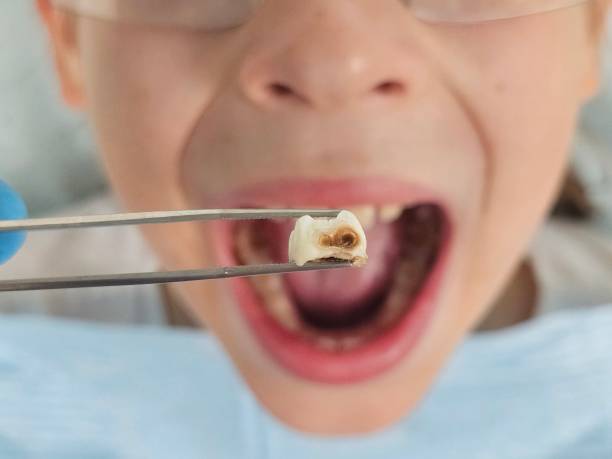 Best Broken or Cracked Tooth Emergency Dentist in Anna, IL